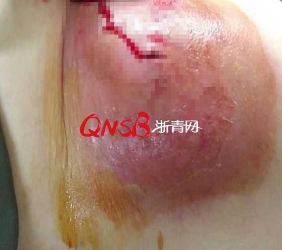 杭州一55岁女子腰部红肿痛,最后医生从中取出了一堆"红色腐乳"!
