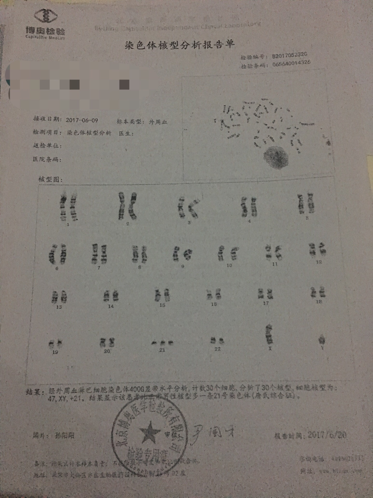 李槟槟的染色体核型分析报告单,他被确诊为患21-三体综合征,既唐氏