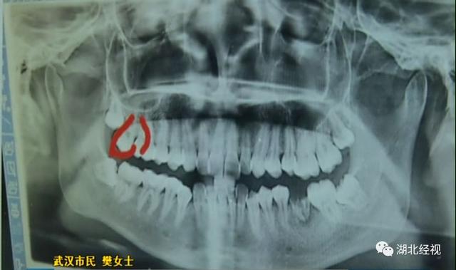 武汉女孩拔智齿,回家一看好牙没了!傻眼