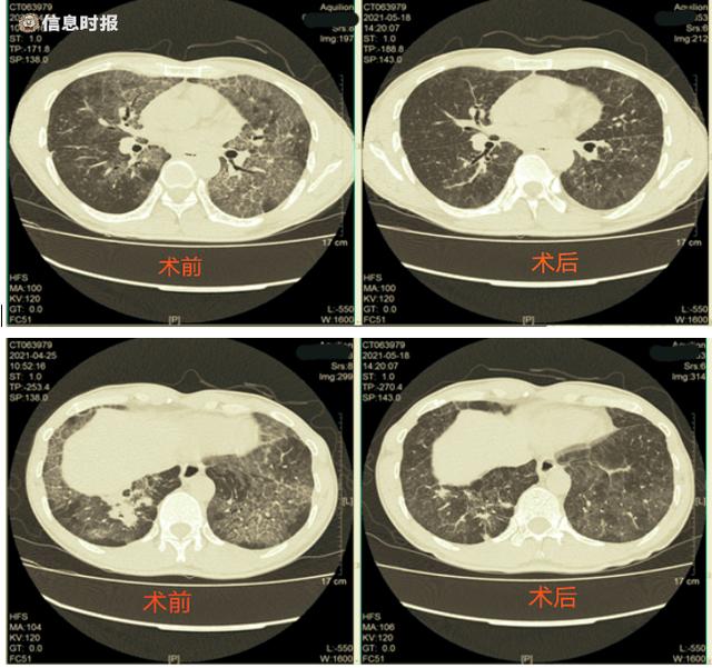 图片新闻  一看到林先生此前在外院检查的胸部ct,主任医师蒋文中便