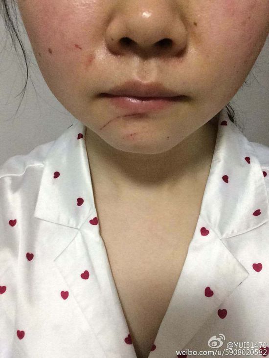 其微博发布的照片显示，她脸部有多处抓挠伤痕。