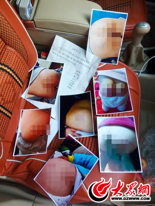 王先生提供的7名孩子屁股受伤的照片 大众网 图
