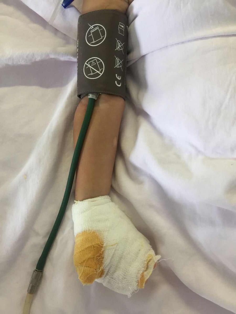 将金属饭叉插入接线板,两岁女童被"电飞",左手受损严重