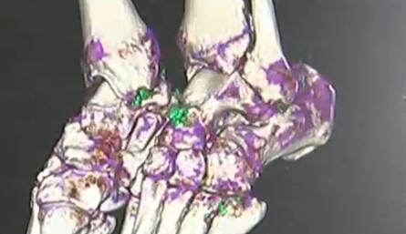 平时饮料当水喝,几年后变成这样戒也晚了