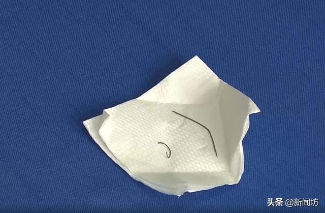 『异物』上海老伯下半身藏针60多年!医生都惊了:你就没感觉?