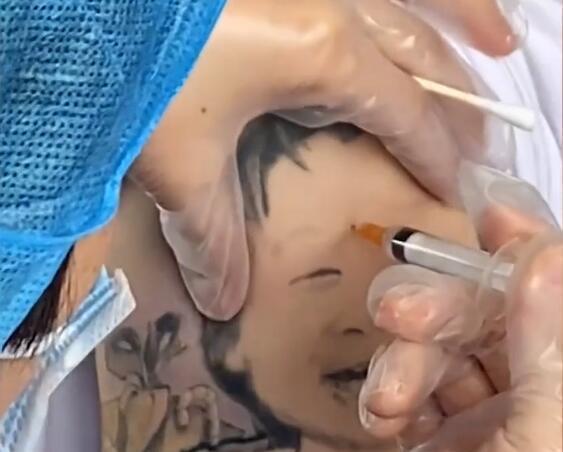 医生|男子打疫苗露出可爱纹身 注射位置刚好在纹身女孩的脑门上