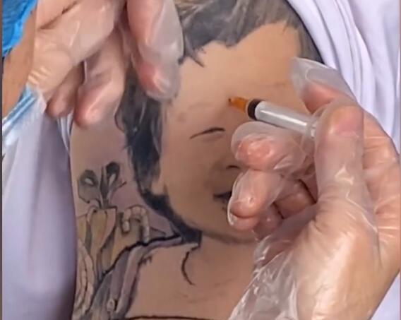 医生|男子打疫苗露出可爱纹身 注射位置刚好在纹身女孩的脑门上