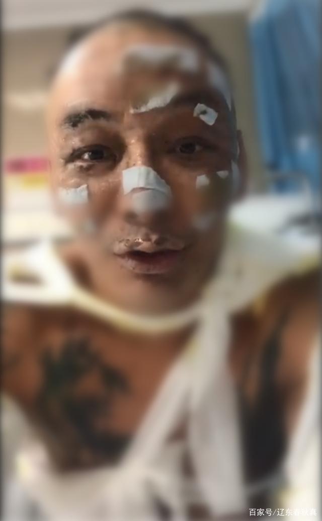 diss|歌手徐真真全身二级深度烧伤 睡前点香薰蜡烛酿祸