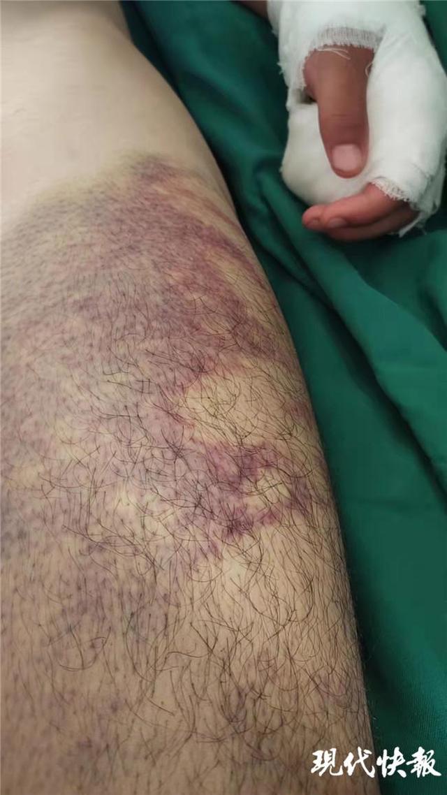 殴打|张家口一15岁男生遭老师殴打后颅内血肿，涉事老师：头是他道歉磕伤的