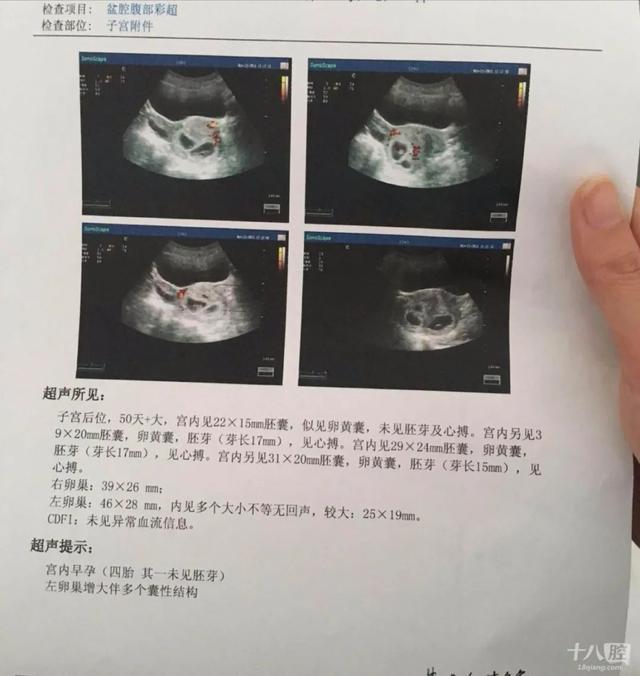 #养孩子#浙江男子带老婆做孕检，一查肚子里竟有4个...网友算了笔帐，一般人真不知道