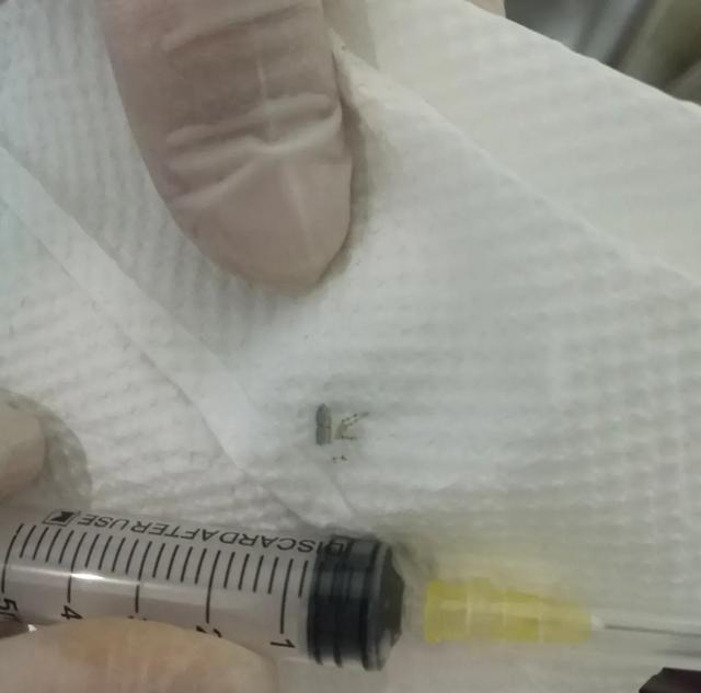 「医生」毛骨悚然!女子突然耳鸣刺痛,医生一看惊了