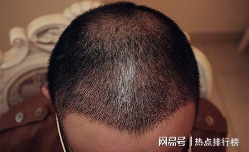 暗访|新华社暗访植发市场 技术包装蒙外行“速成医生”浑水摸鱼