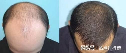 暗访|新华社暗访植发市场 技术包装蒙外行“速成医生”浑水摸鱼