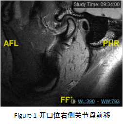 颞下颌关节紊乱综合征|