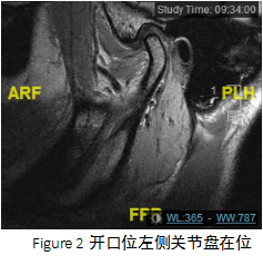 颞下颌关节紊乱综合征|