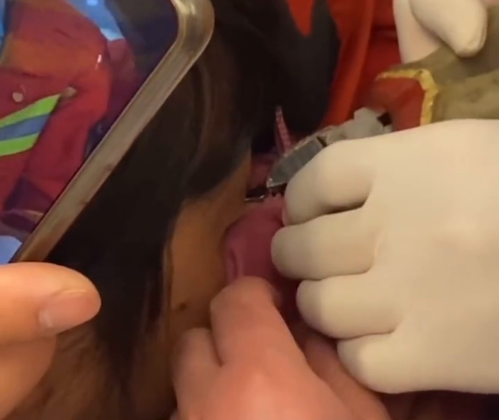 夹住|看着都疼!杭州一女子眼皮被拉链夹住,求助消防