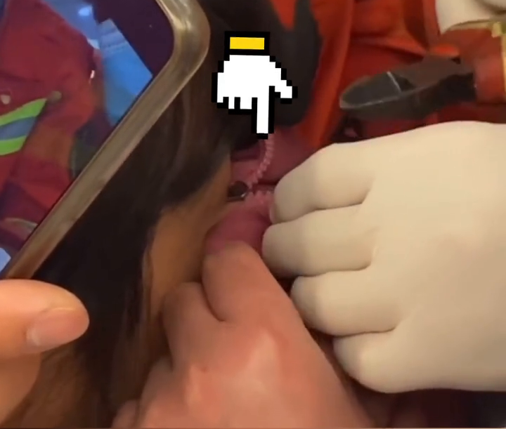 夹住|看着都疼!杭州一女子眼皮被拉链夹住,求助消防